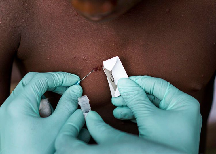 Mpox in Cross River